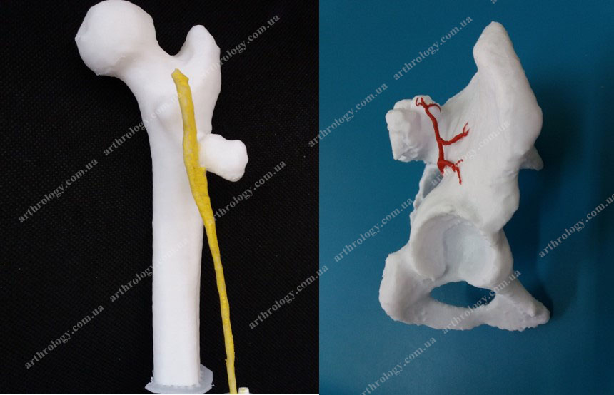 Остеохондрома стегнової кістки, що підтискає сідничний нерв. Остеохондрома клубової кістки поруч із гілками сідничної артерії. Операції при пухлинах кістково-суглобової системи 