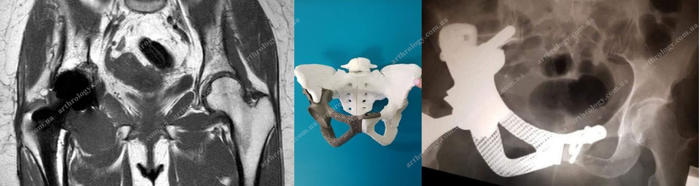 Хондросаркома G1 клубової кістки справа (стан після ендопротезування кульшового суглоба). Вперше в Україні автором виконано надацетабулярну резекцію кісток тазу із імплантацією індивідуального анатомічного 3D-друкованого тазового ендопротеза