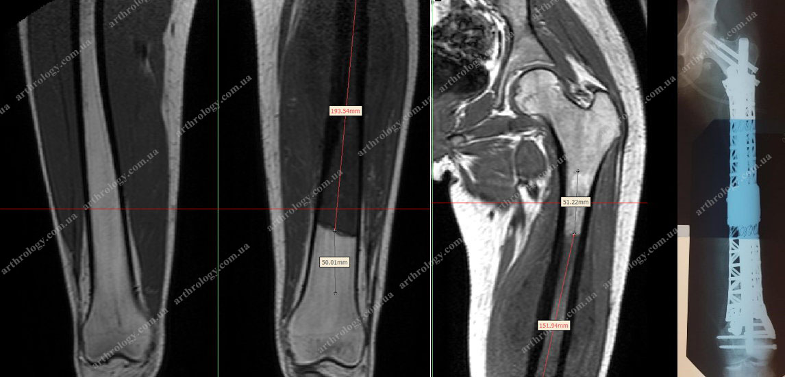Остеосаркома діафізу лівої стегнової кістки. Автор вперше в Україні виконав ендопротезування діафізу стегнової кістки із використанням індивідуального анатомічного 3D-друкованого імплантата 