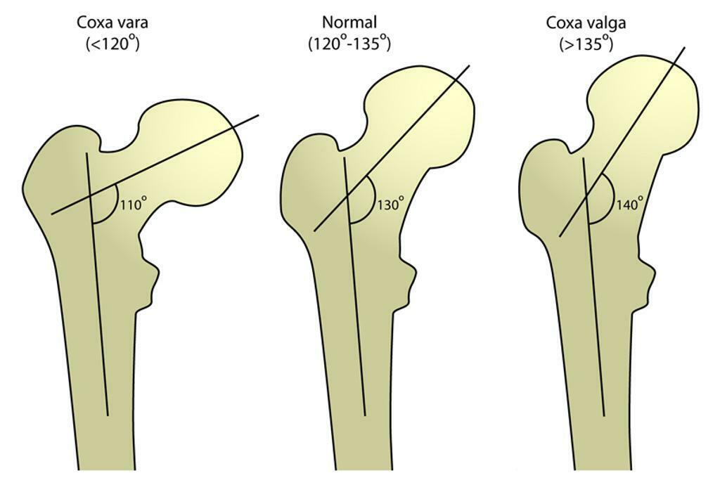 Coxa valga (Диспластичний коксартроз) - це деформація проксимального відділу стегнової кістки, при якій шийково-діафізарний кут > 135°