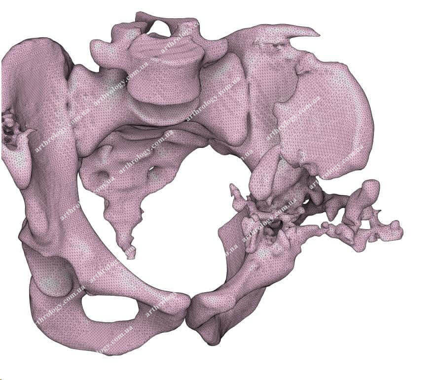 Ендопротезування лівого кульшового суглоба із застосуванням індивідуальної 3D-друкованої ацетабулярної системи (тип "ice cream cone"). 