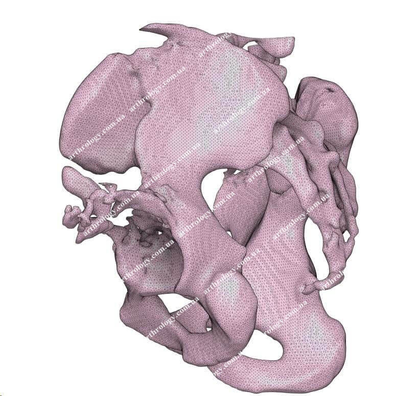 Ендопротезування лівого кульшового суглоба із застосуванням індивідуальної 3D-друкованої ацетабулярної системи (тип "ice cream cone").