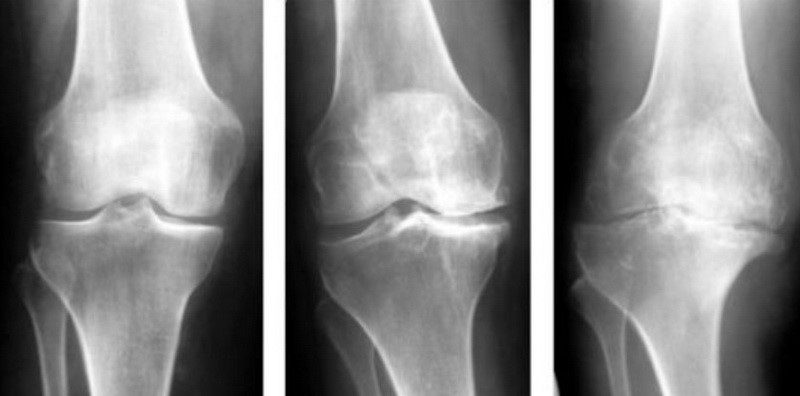 Синдром «офісного коліна»  - один з різновидів раннього остеоартрозу колінного суглоба - гонартрозу. Цей стан пов'язаний із тривалим сидінням на одному місці, гіподинамією і поширеним серед офісних службовців ожирінням, причому суглоби ніг у цьому випадку опиняються у самому фізіологічно невигідному положенні. 
