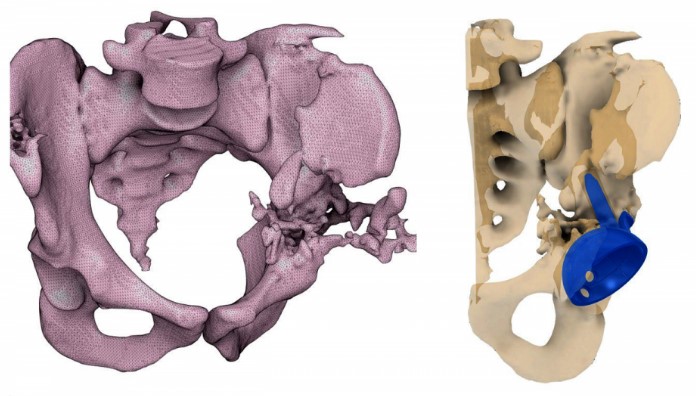 Вогнепальний дефект кістки в ділянці лівого кульшового суглоба та спроектований імплантат в електронному вигляді.
