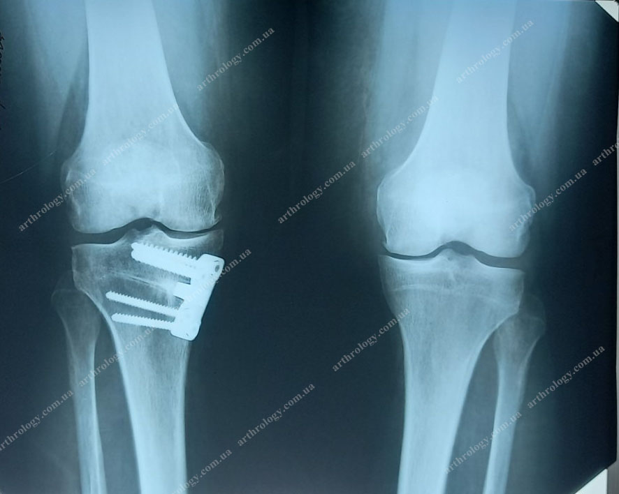 Коригуюча остеотомія як альтернатива ранньому одновиростковому ендопротезуванню колінного суглоба при гонартрозі?