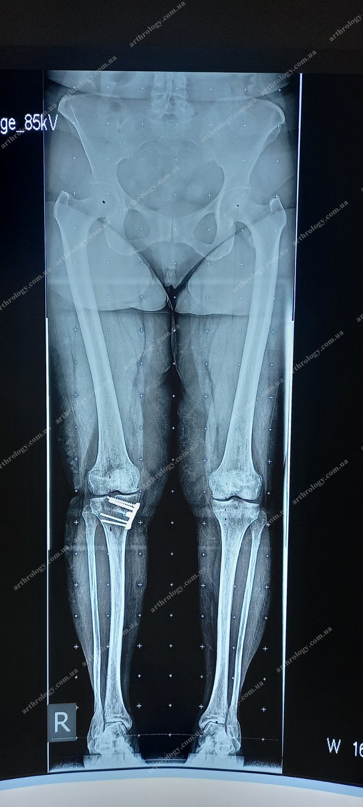 Коригуюча остеотомія як альтернатива ранньому одновиростковому ендопротезуванню колінного суглоба при гонартрозі?