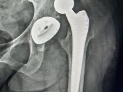 Why a hip prosthesis luxates?