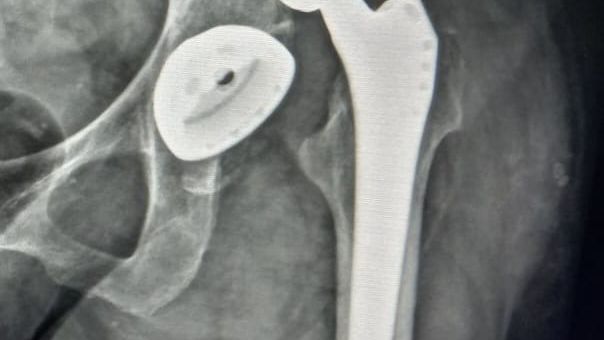 Why a hip prosthesis luxates?