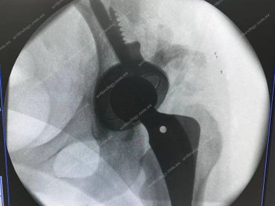 Arthroplasty of the left hip using a customized 3D-printed acetabular system