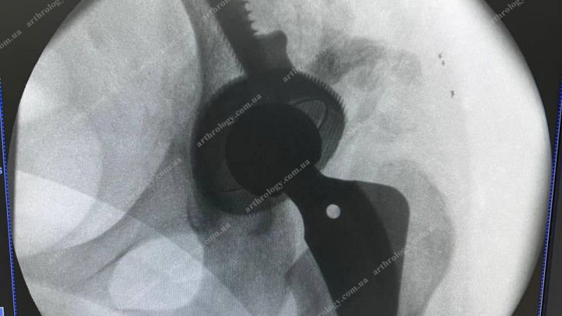 Arthroplasty of the left hip using a customized 3D-printed acetabular system