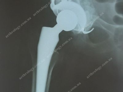 Revision hip arthroplasty