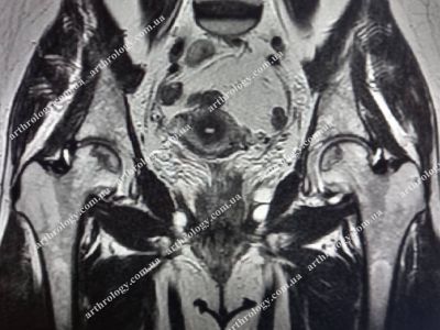 How COVID-19 affects joints?