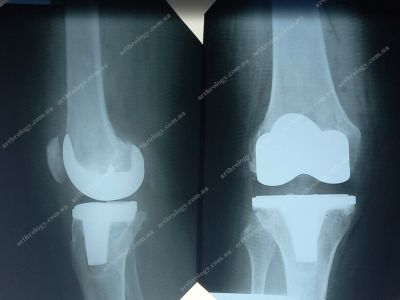 Knee arthroplasty