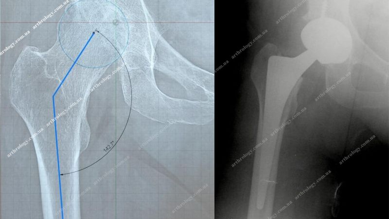 Dysplastic coxarthrosis or Coxa valga - hip arthroplasty (replacement)
