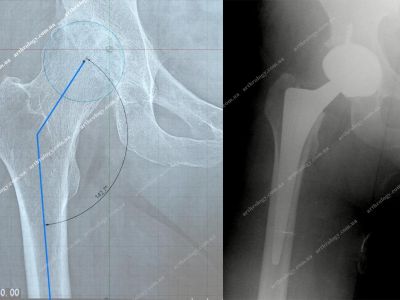 Dysplastic coxarthrosis or Coxa valga - hip arthroplasty (replacement)