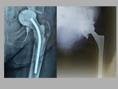 An example of revision endoprosthesis of the hip joint