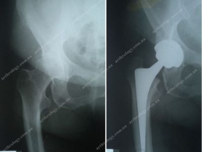 Hip arthroplasty