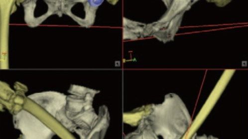 Use of computer navigation in total hip arthroplasty (literature review)