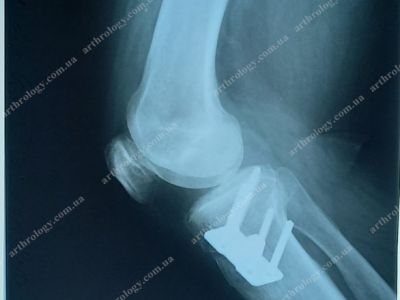 Could a corrective osteotomy be an alternative to the early unilateral knee arthroplasty as gonarthrosis treatment?