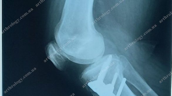 Could a corrective osteotomy be an alternative to the early unilateral knee arthroplasty as gonarthrosis treatment?