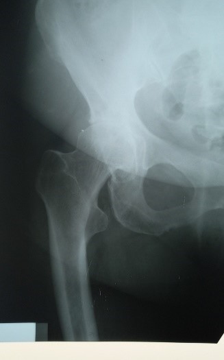 Hip arthroplasty