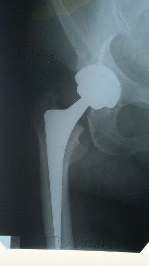 Hip arthroplasty