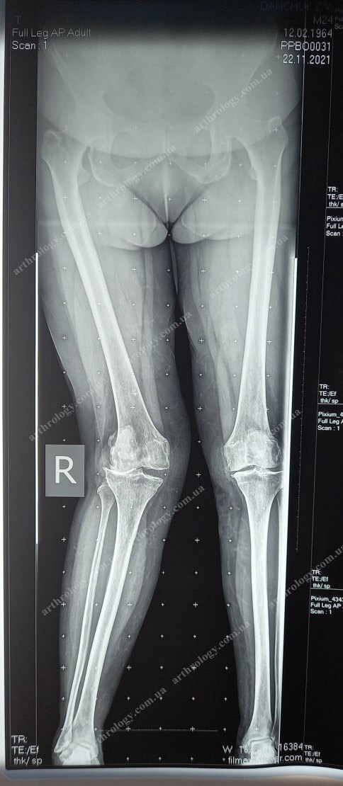 Knee arthroplasty