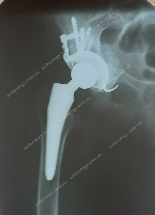 Cup instability and the result of the revision hip arthroplasty with a 3D-printed construction 