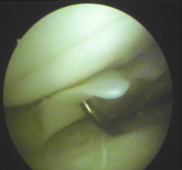 Damaged medial meniscus of a knee 