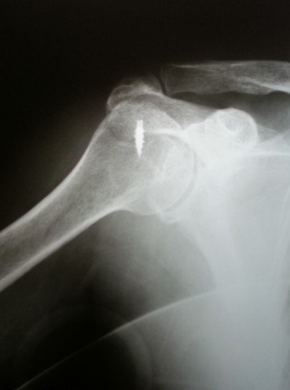 Ruptured m.supraspinatus of a right shoulder  Surgical operation: the arthroscopic suture of the right shoulder’s m.supraspinatus fixed with an anchor