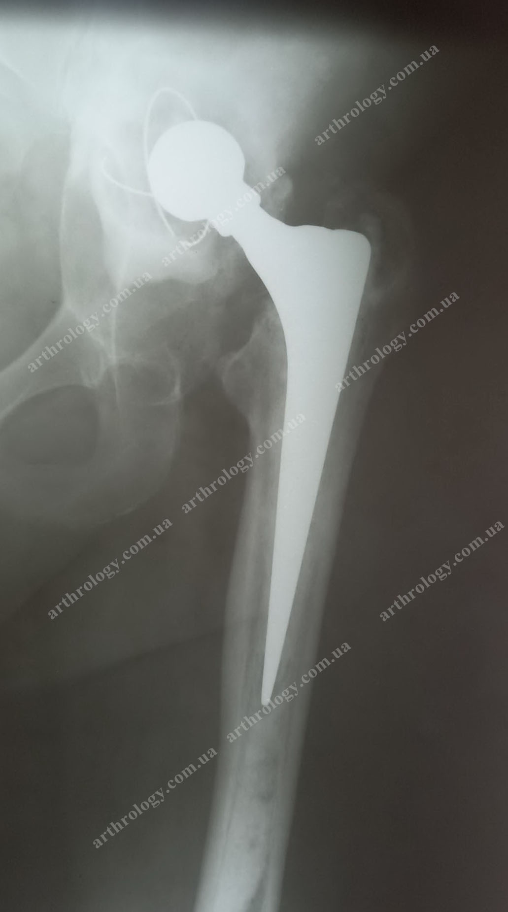 The use of an individual 3D-printed titanium acetabular system with bone alloplastic for massive lesions of acetabular cavity