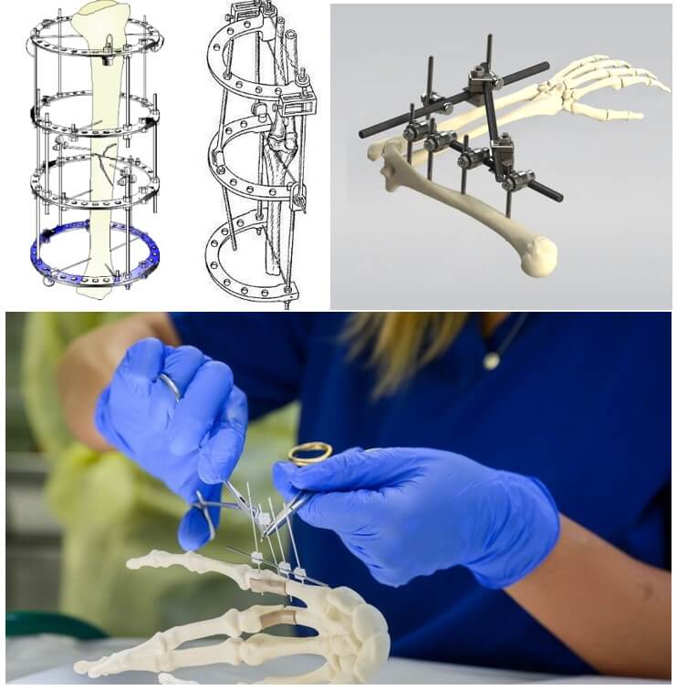 Osteosynthesis or metal osteosynthesis in bone fractures’ treatment. Different external fixation devices
