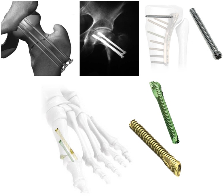 Screws for perosseous osteosynthesis 