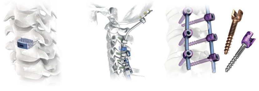 Implants for osteosynthesis of the spine produced by ChM