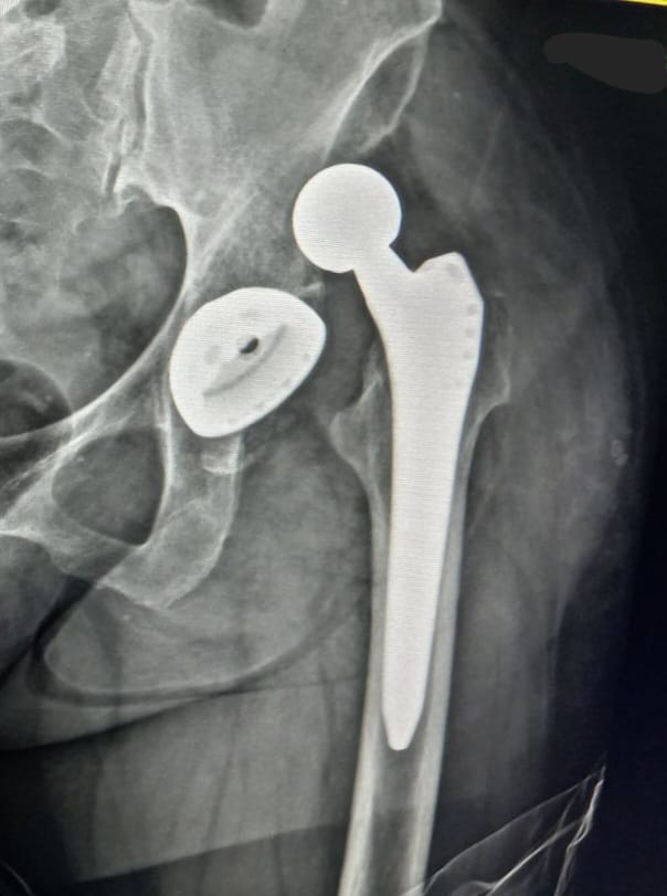 Why a hip prosthesis luxates? 