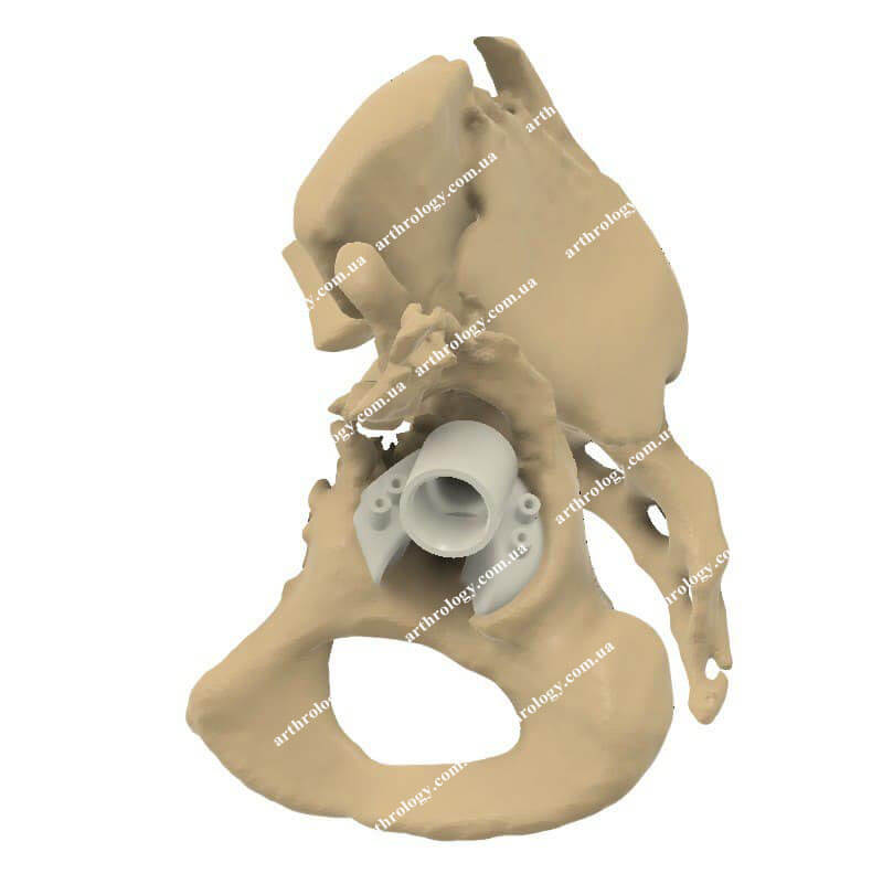 Arthroplasty of the left hip using a customized 3D-printed acetabular system