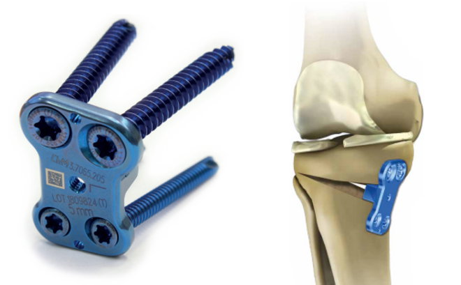 The place for corrective tibial osteotomy