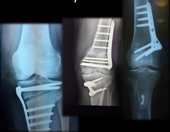 Could a corrective osteotomy be an alternative to the early unilateral knee arthroplasty as gonarthrosis treatment? 