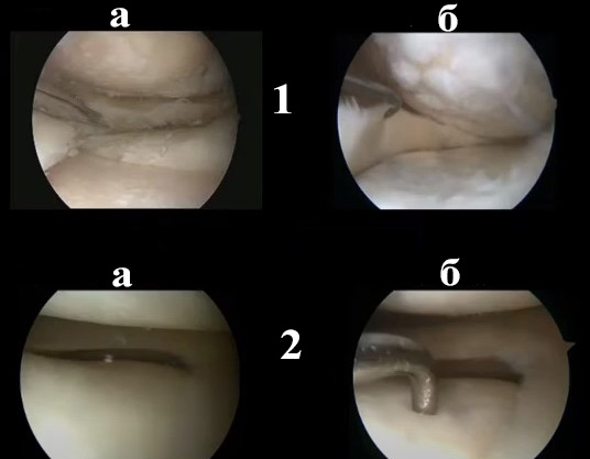 Could a corrective osteotomy be an alternative to the early unilateral knee arthroplasty as gonarthrosis treatment? 