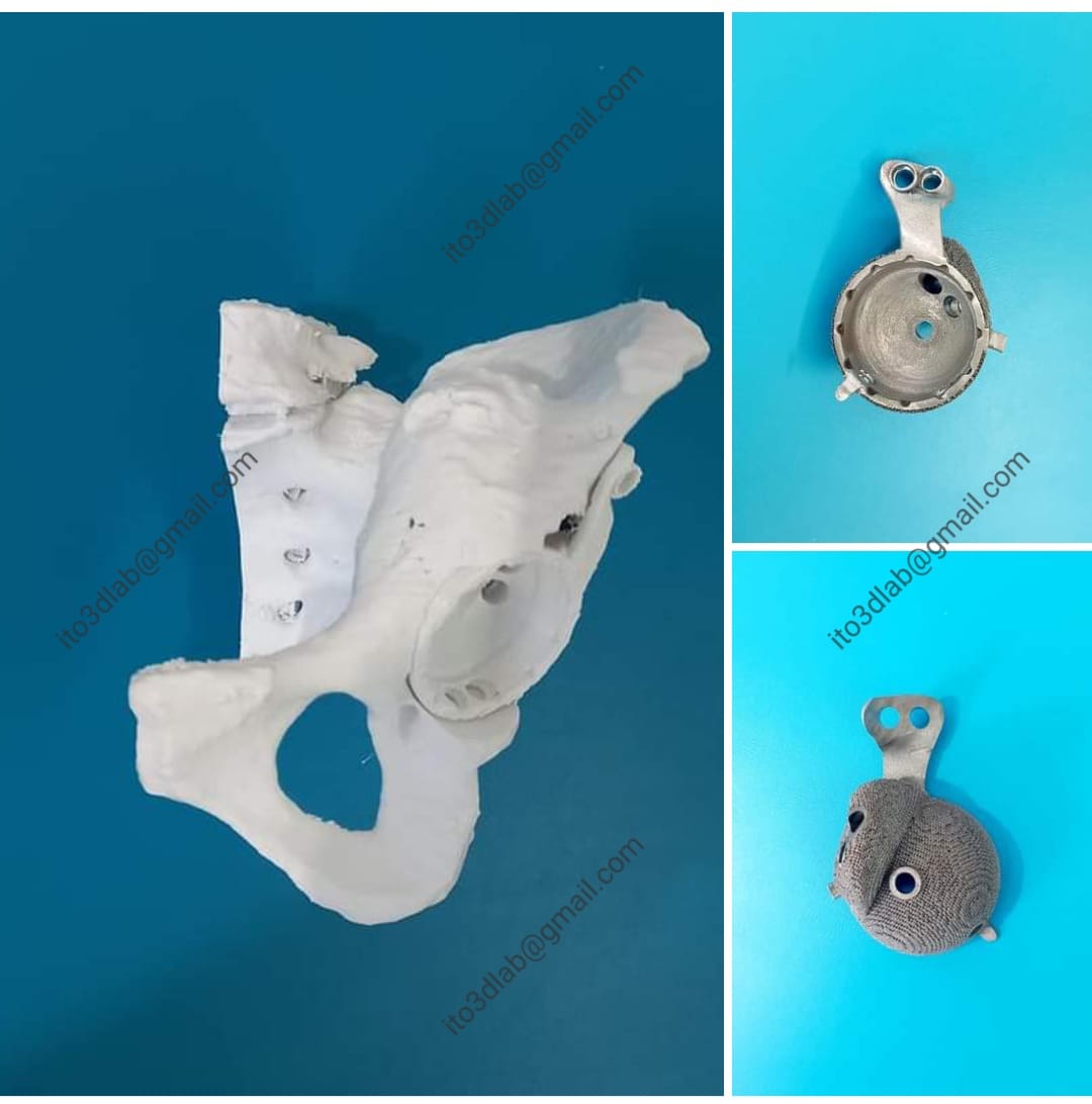 Использование индивидуальной 3D-печатной титановой ацетабулярной системы с костной аллопластикой при массивных дефектах вертлужной впадины.