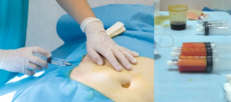Клеточная терапия – Регенеративные технологии в травматологии-ортопедии