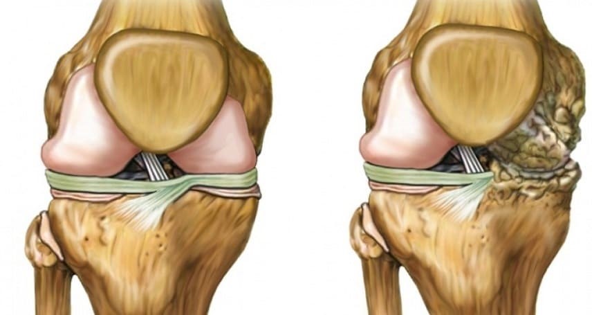 Корригирующая остеотомия как альтернатива раннему одномыщелковому эндопротезированию коленного сустава при гонартрозе?