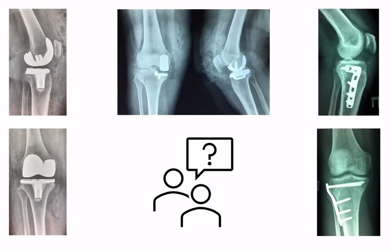 Рекурвация колена — Википедия